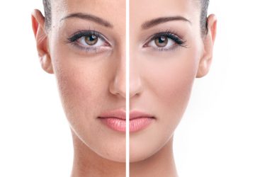 skin treatment in Delhi - vivaesthetique