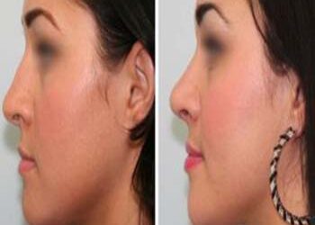 face lift surgery in Delhi - vivaesthetique