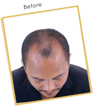 hair transplant in India | hair transplant in Delhi - vivaesthetique